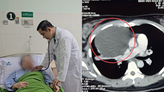 Nội soi lấy khối u “khủng” chèn ép tim phổi người phụ nữ ở miền Tây
