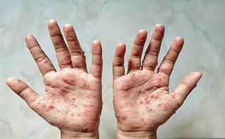 Bệnh viện đầu ngành truyền nhiễm chuẩn bị ứng phó với đậu mùa khỉ