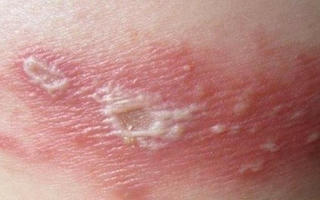 Biến chứng nguy hiểm của bệnh zona thần kinh