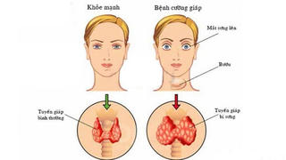 Có thể chữa khỏi hoàn toàn bệnh bướu cổ không?