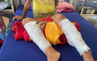 Quảng Bình: Công an vào cuộc điều tra vụ cháu bé bị cha đẻ đốt bỏng 2 chân