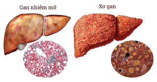 Gan nhiễm mỡ có gây ung thư?