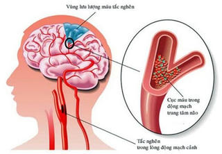 Dấu hiệu khi bạn bị thiếu máu não