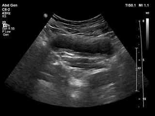 Không chủ quan với bệnh viêm đường tiết niệu