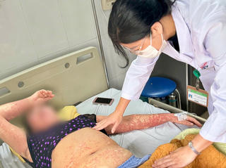 Mặt biến dạng, toàn thân phát ban vì dị ứng thuốc