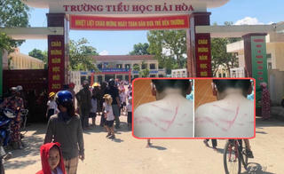 Vụ học sinh bị đánh bầm tím ở lưng: Đình chỉ công tác giáo viên chủ nhiệm 15 ngày 