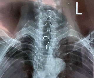 Cụ ông 83 tuổi nuốt phải lưỡi câu vào trong thực quản