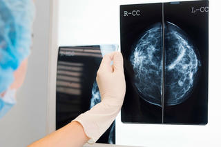 AI 'trợ lực' của bác sĩ trong phát hiện ung thư