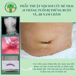 Cứu bé trai 18 tháng bị thủng ruột vì bi nam châm