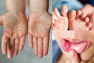 Không chủ quan với bệnh tay chân miệng
