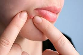 Cảnh báo biến chứng nguy hiểm từ thói quen nặn mụn