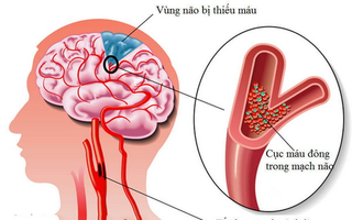 Phân biệt đột quỵ và co giật