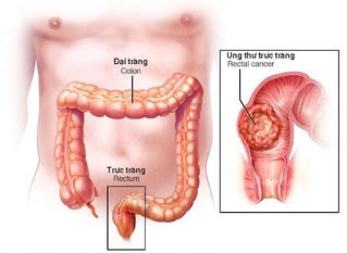Mỗi năm, có khoảng 16.000 ca ung thư đại trực tràng mới