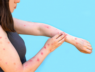Bệnh đậu mùa khỉ có thể lây truyền từ mẹ sang con
