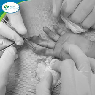 Nối gân ngón tay đứt rời cho bé gái bị tai nạn sinh hoạt