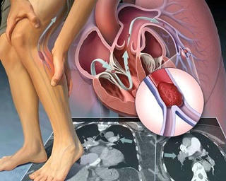 Tắc động mạch chi dưới vì hút thuốc lá