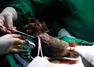 Búi tóc nặng gần 1 kg trong bụng cô gái 17 tuổi