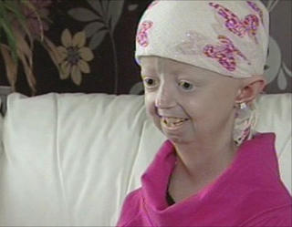 Hiện tượng lạ: Bệnh  “lão nhi”