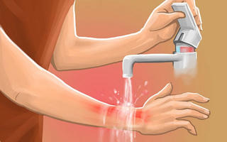 Khi bỏng nước sôi