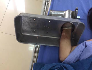 Cấp cứu bệnh nhân tổn thương tay do máy xay thịt