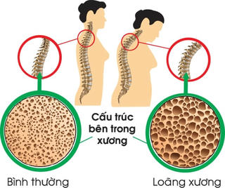 Chớ coi thường bệnh loãng xương