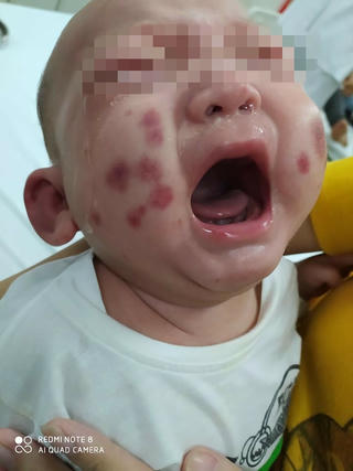 Điều trị thành công ca bệnh chưa từng có tại Việt Nam