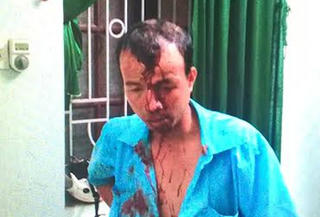 Thanh Hóa: Nhân viên bán vé xe buýt bị người nhà hành khách dùng súng đánh toác đầu