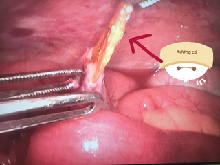 Cứu sống bệnh nhân bị xương cá đâm thủng ruột