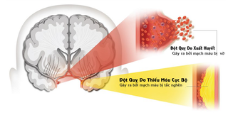 Cần theo dõi sức khoẻ hàng ngày, nhận biết các dấu hiệu đột quỵ sớm