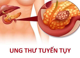  Cảnh báo những thói quen xấu gây ung thư tụy