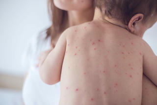 Hà Nội: Nhiều ca bệnh nặng vì sởi