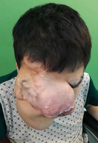 Ca mổ kỷ lục lấy lại gương mặt cho bệnh nhân mắc khối u ‘khủng’