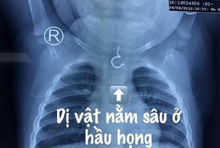 Bé gái 1 tuổi suýt gặp họa lớn khi giật khuyên tai bằng vàng của bạn để... nuốt