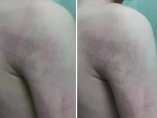 Học sinh lớp 1 bị cô giáo chủ nhiệm đánh thâm tím người