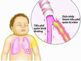 Khám hô hấp chiếm 50%, trẻ ho như rút ruột khi chuyển mùa