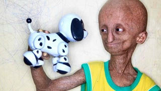 Mắc bệnh lạ, bé trai 14 tuổi già như ông lão