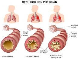 3.000 người tử vong vì bệnh hen mỗi năm