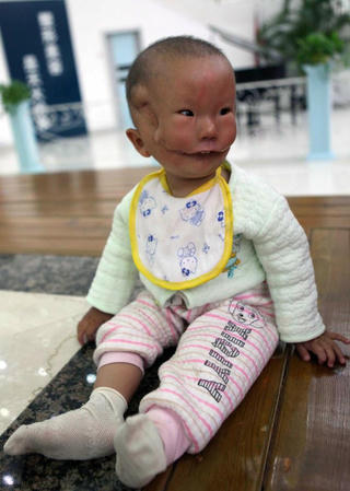 Bé trai 'mặt nạ'được nhiều người yêu mến
