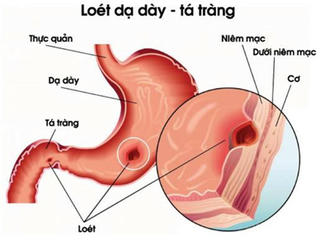 Những ai dễ bị  viêm loét dạ dày?