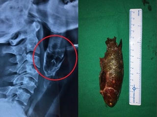 Cá sống dài 11 cm kẹt trong họng người đi câu