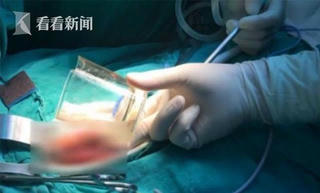 Hy hữu, cốc thuỷ tinh mắc kẹt trong người