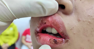 Dị ứng môi sưng mủ vì mua son trôi nổi trên mạng