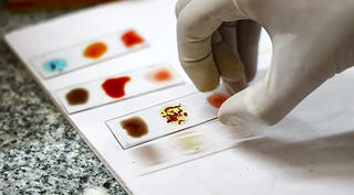 Rh null – nhóm máu hiếm nhất hành tinh