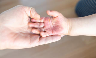 Tai nạn bỏng ở trẻ em, hiểm họa từ những phút lơ là