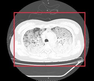 Cúm mùa diễn biến nguy kịch trên bệnh nhân suy giảm miễn dịch