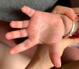 TP Hồ Chí Minh ghi nhận hơn 7.200 ca tay chân miệng, chủng EV71 xuất hiện trở lại