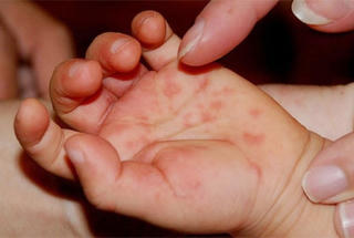 Gia tăng ca mắc tay chân miệng, Bộ Y tế yêu cầu tăng cường kiểm soát dịch